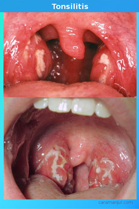 gambar tenggorokan terkena tonsilitis