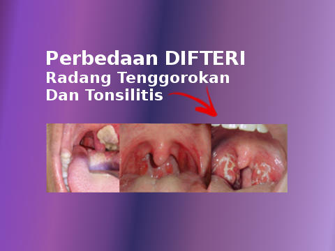 Perbedaan Difteri, Radang Tenggorokan, dan Amandel (Tonsilitis)