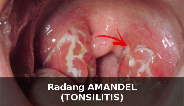 Radang Amandel (Tonsilitis): Ciri, Gejala, Penyebab, & Cara Mengobati