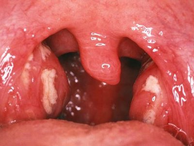 amandel membesar pada anak karena tonsilitis